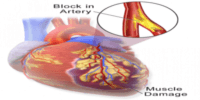 Heart Disease Prediction